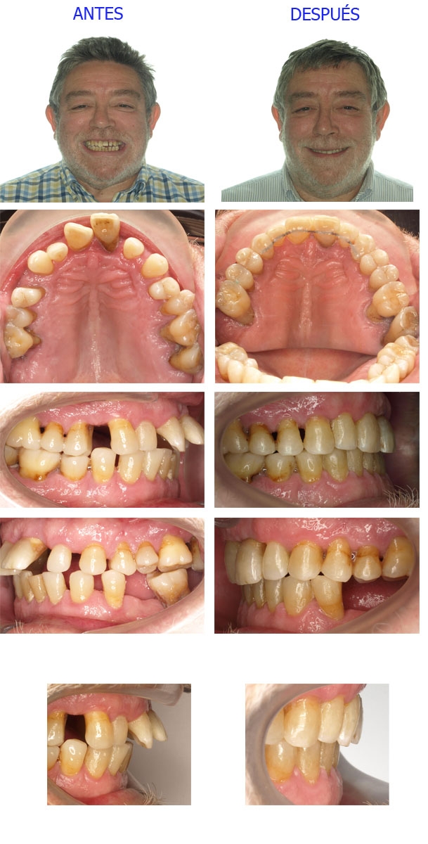 Caso de ortodoncia en adulto en Zaragoza